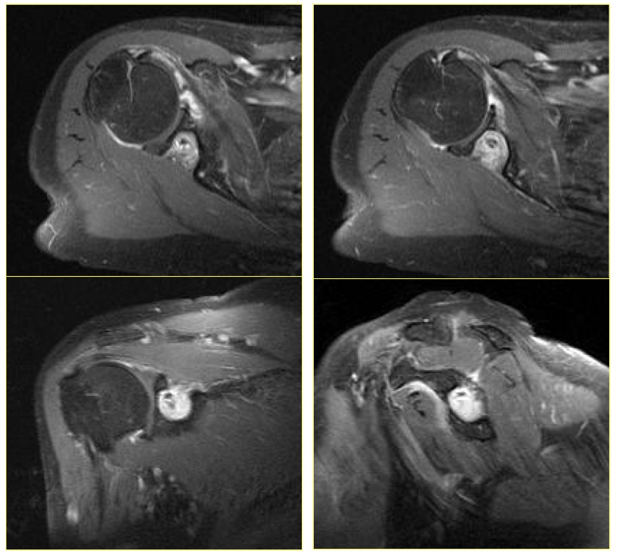 Figure 3 for case inflammatory pseudotumor ( RID3860 )